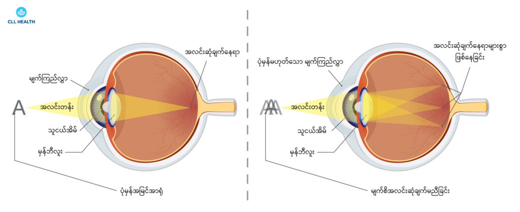 refractive errors image 3