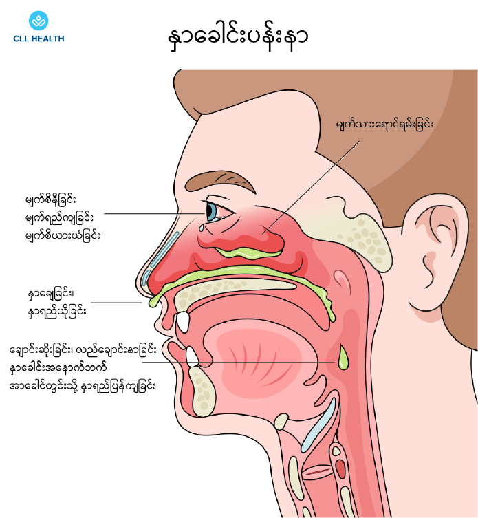 allergic rhinitis image 1