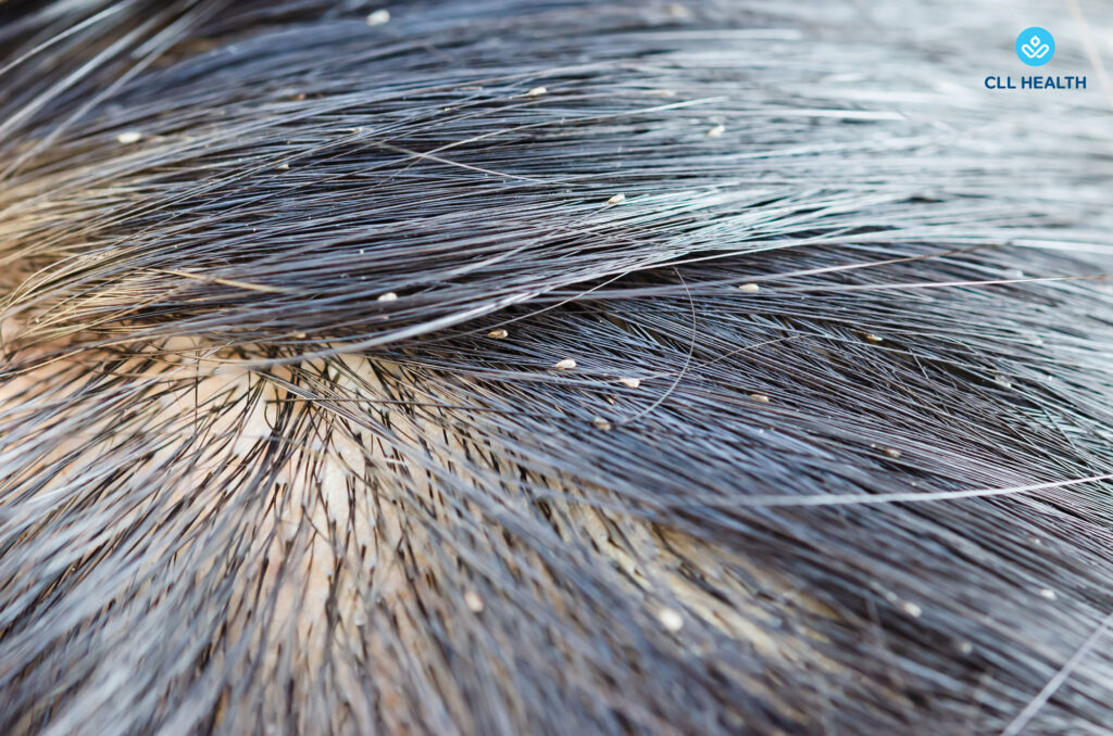 Head and body lice image 1