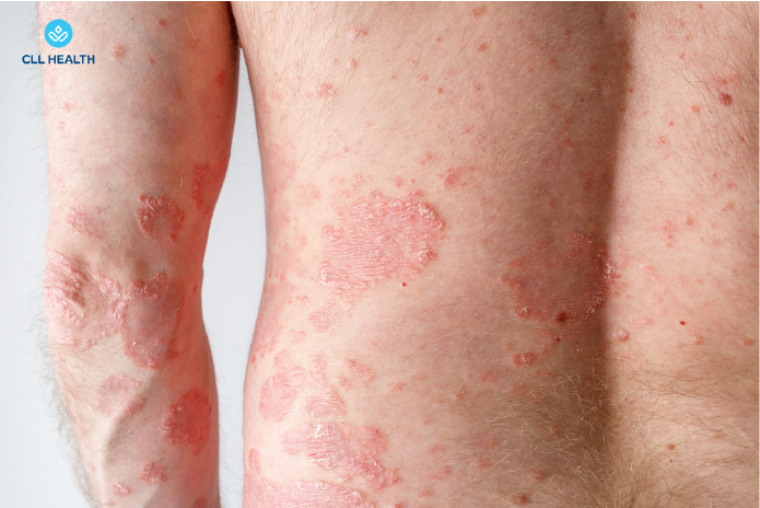 psoriasis image 1