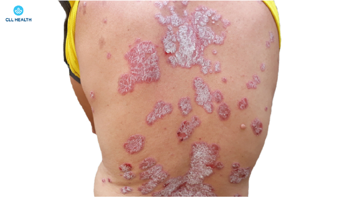 psoriasis image 2