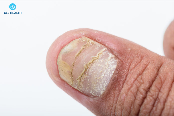 psoriasis image 3