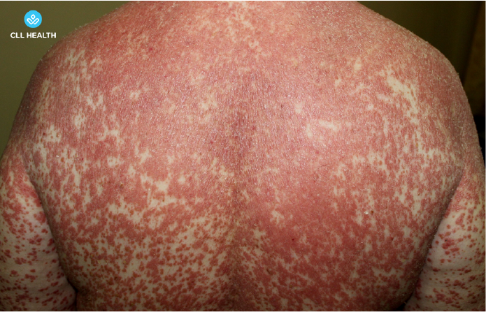 psoriasis image 4