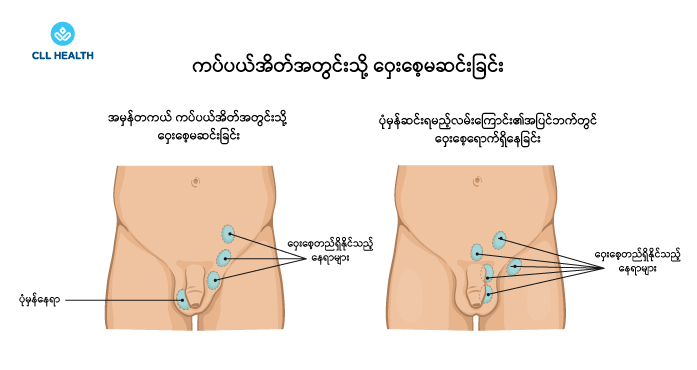 Undescended testis image 1