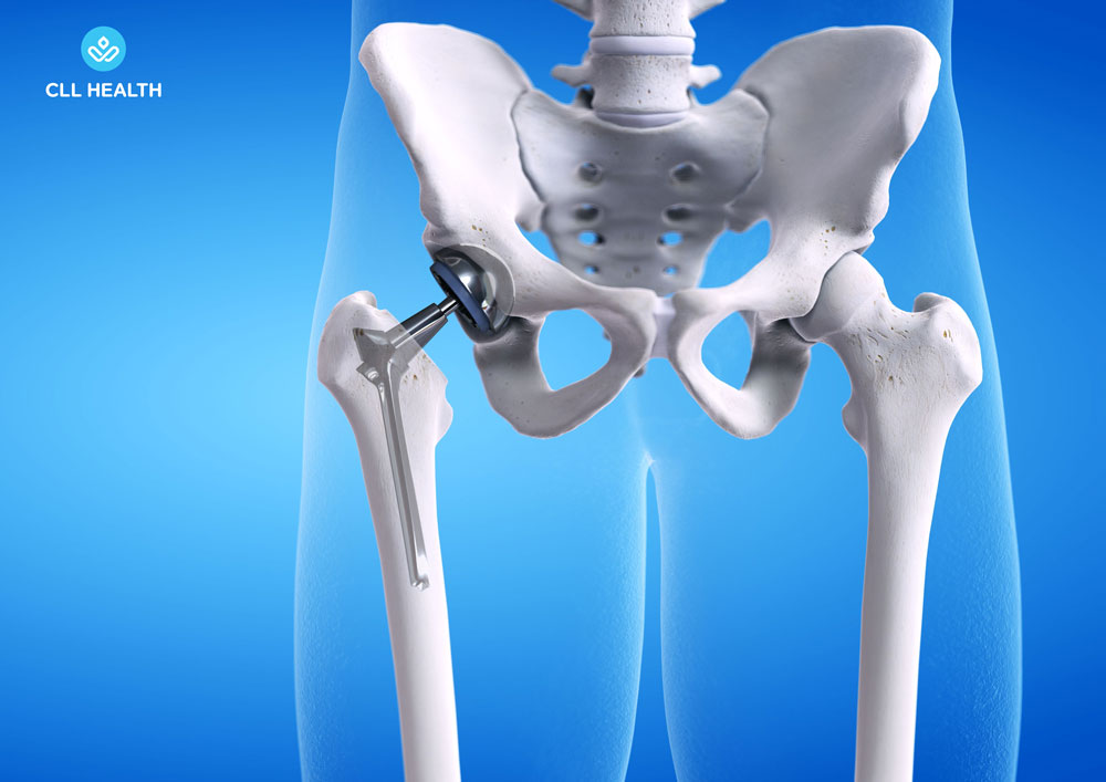 hip replacement surgery image 1
