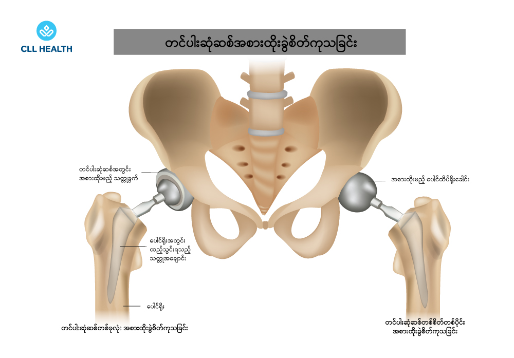 hip replacement surgery image 2