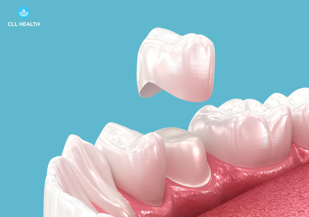 Dental crowns image 1